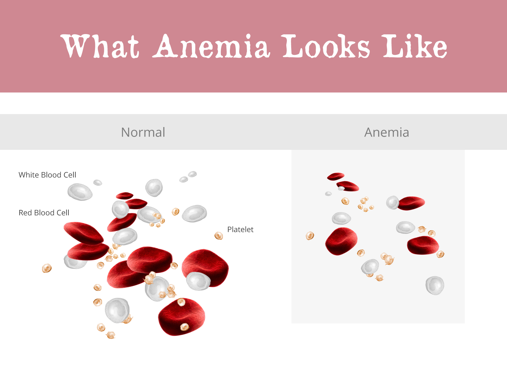 Slide9-Anemia